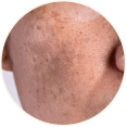 Pigmentation