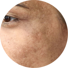 Acne Correction