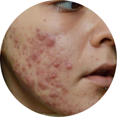 Acne Full