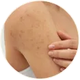 Body Acne Routine