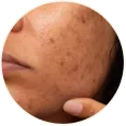 Acne Marks Routine