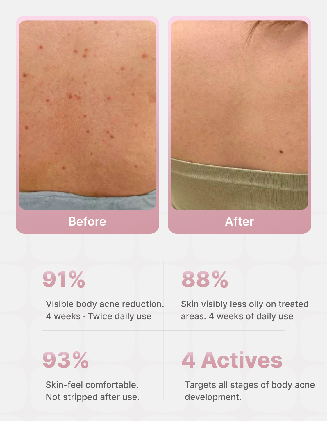 BacneClear™ Body Acne & Spot Corrector Spray