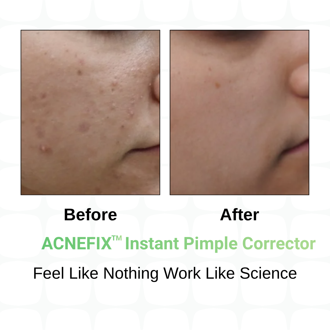 BacneClear Body Acne Spray + AcneFix Instant Pimple Corrector Combo