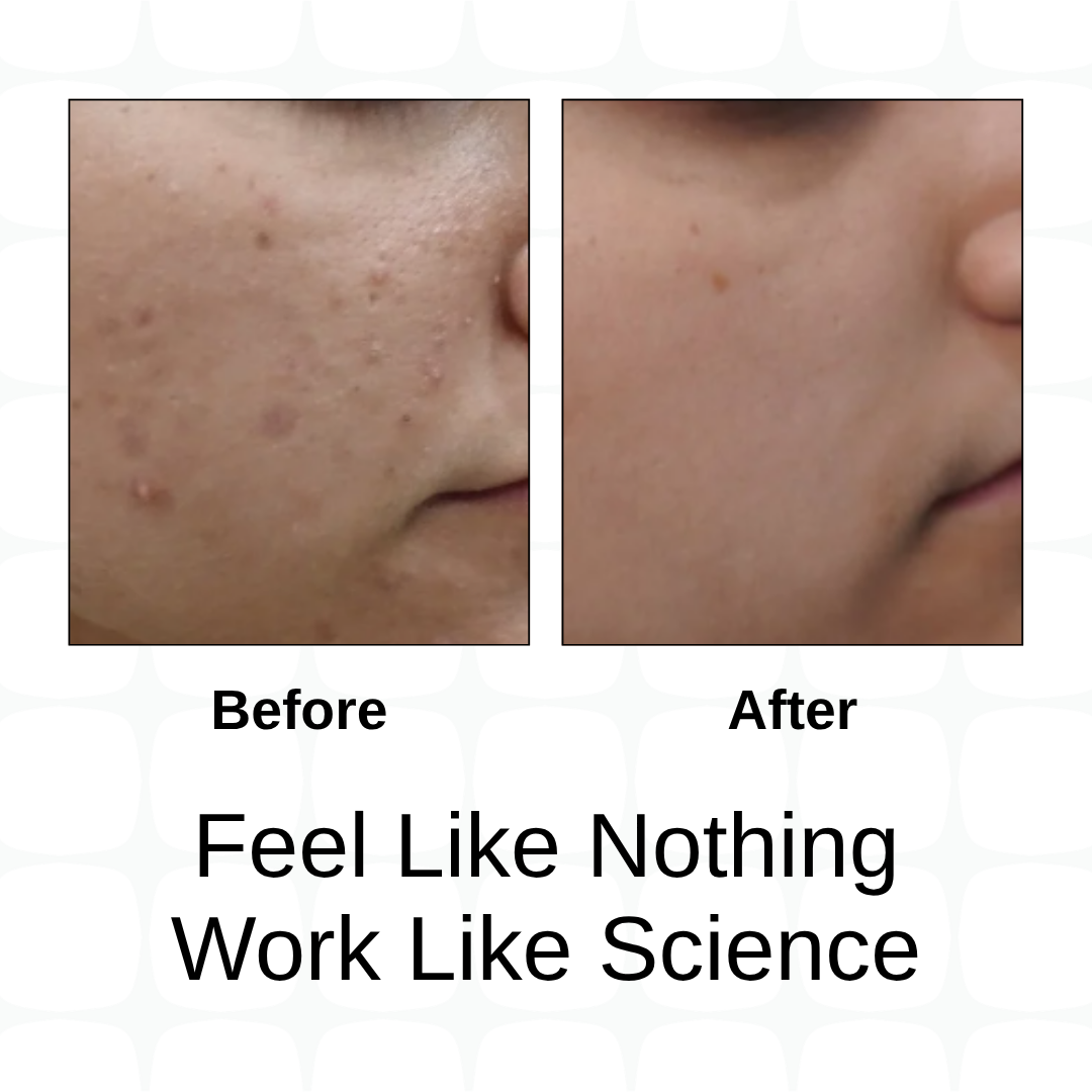 Clarion Oc Moisturizer + AcneFix Instant pimple corrector + Clarify Oc Deep Cleansing Facewash + Encapsulated Sunscreen Combo