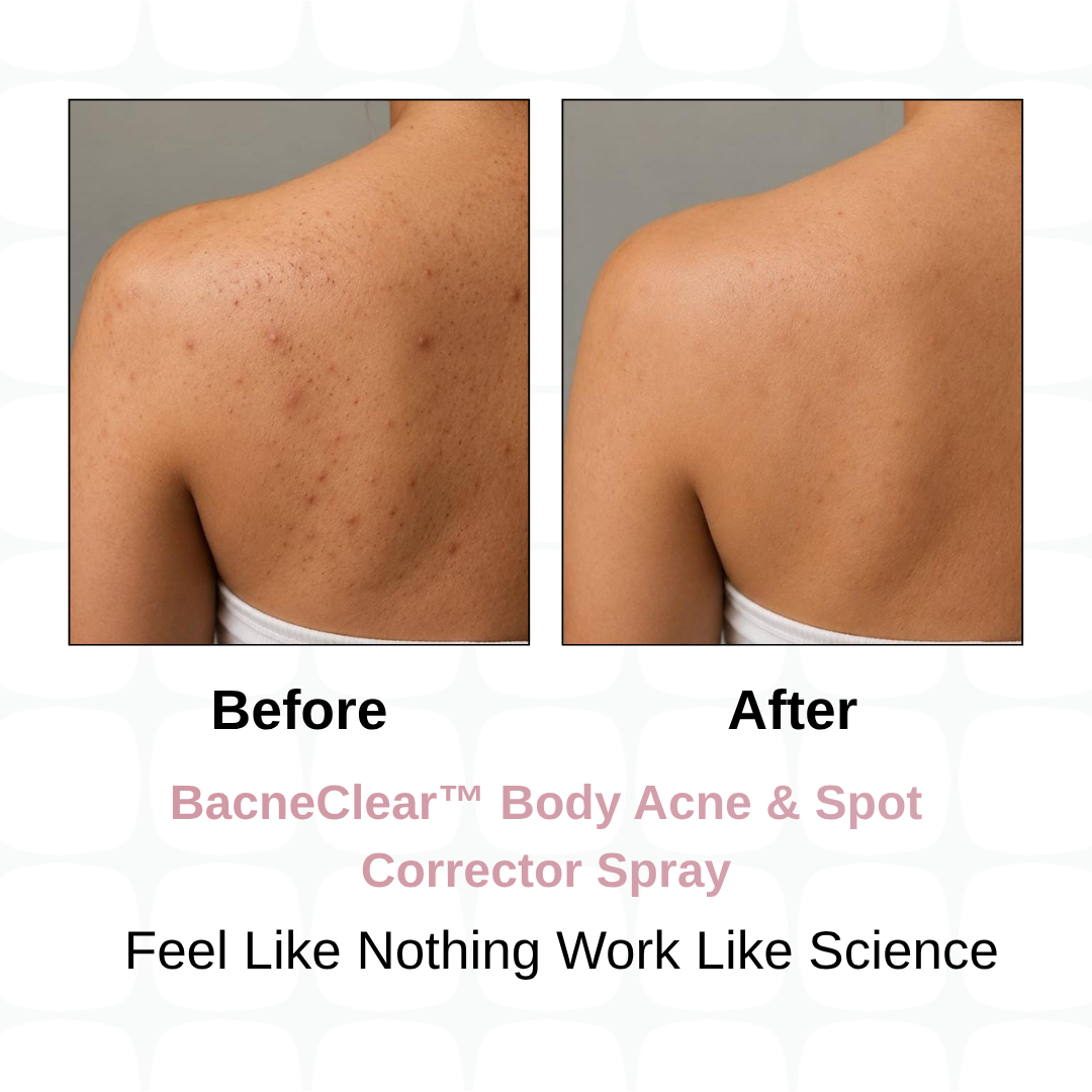 BacneClear Body Acne Spray + AcneFix Instant Pimple Corrector Combo