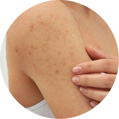 Body acne