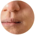 Dry Skin