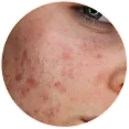 Active Acne Routine