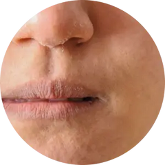 Dry Skin