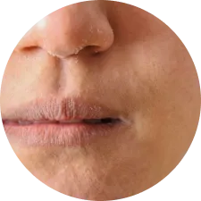 Dry Skin
