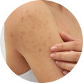 Body Acne Routine