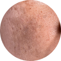 Pigmentation