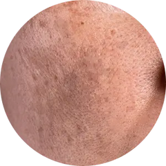 Pigmentation