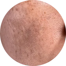 Pigmentation