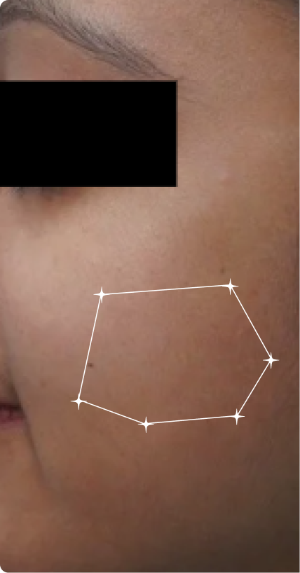 Before — Open pores