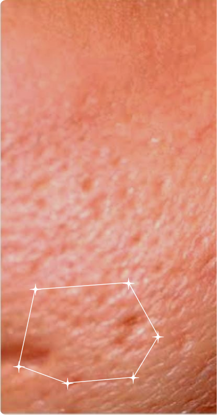 Before — Pore congestion