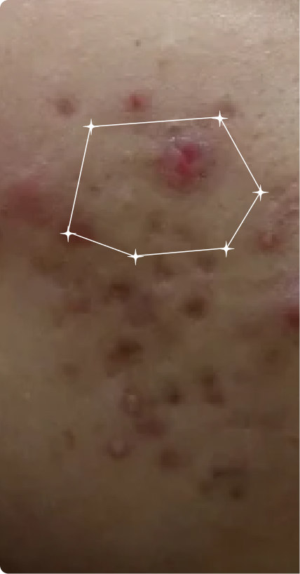 Before — Active Acne