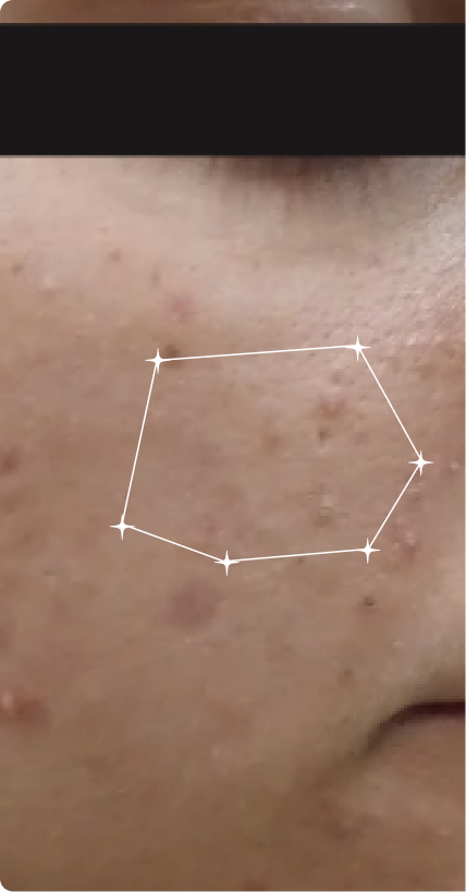 Before — Occasional Acne