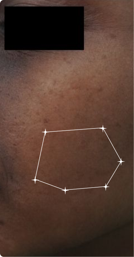 Before — Pigmentation