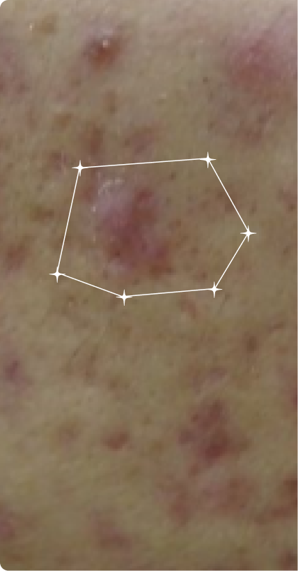 Before — Acne
