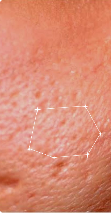 Before — Pore Congestion