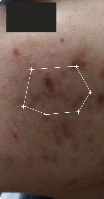 Before — Post Acne marks
