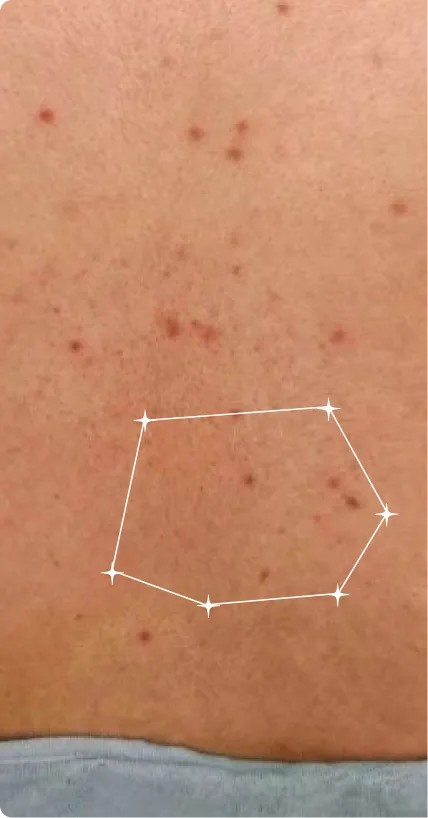 Before — Chest Acne