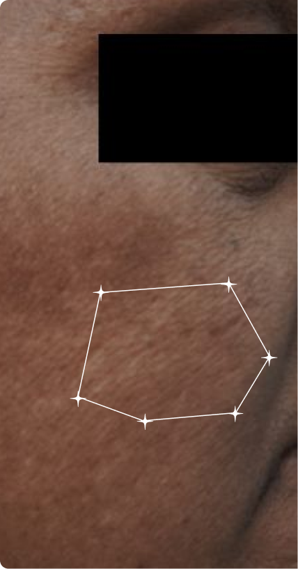 Before — Pigmentation