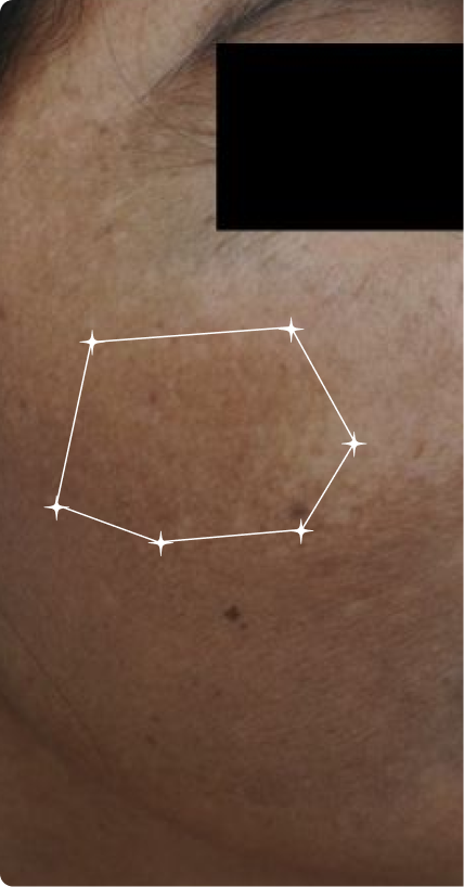 Before — Melasma