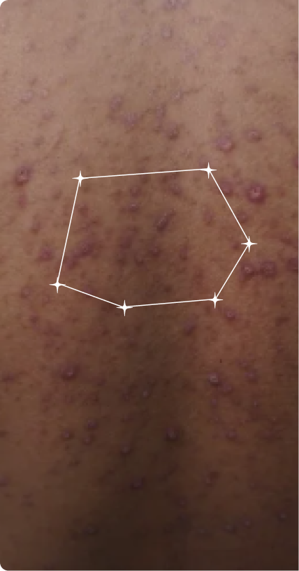 Before — Body Acne
