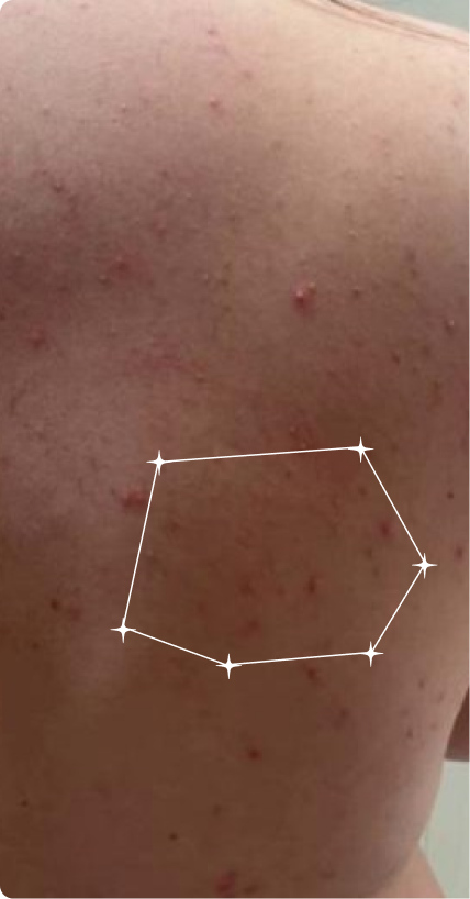 Before — Back Acne