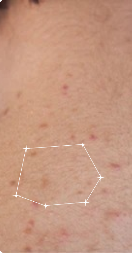 Before — Post-Acne Marks