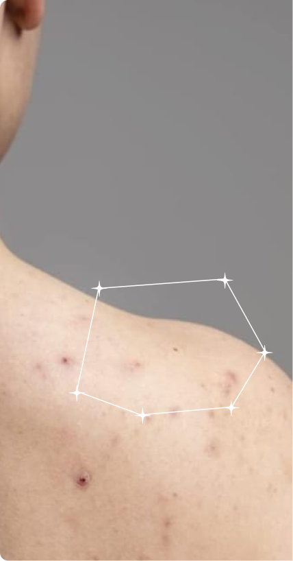Before — Shoulder Acne