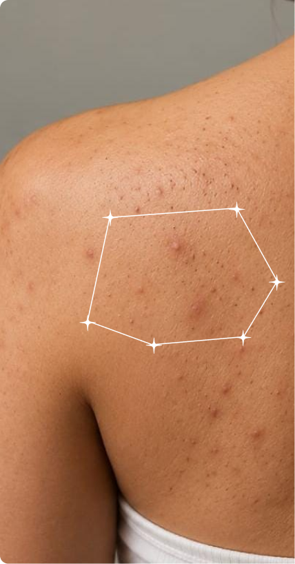 Before — Body Blackheads