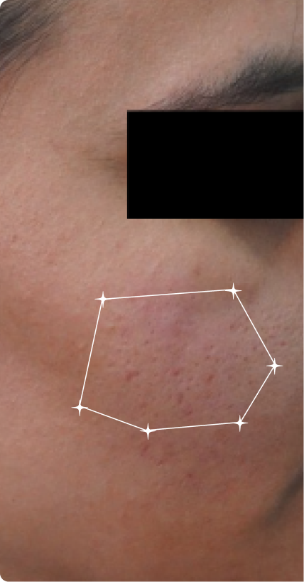 Before — Open pores