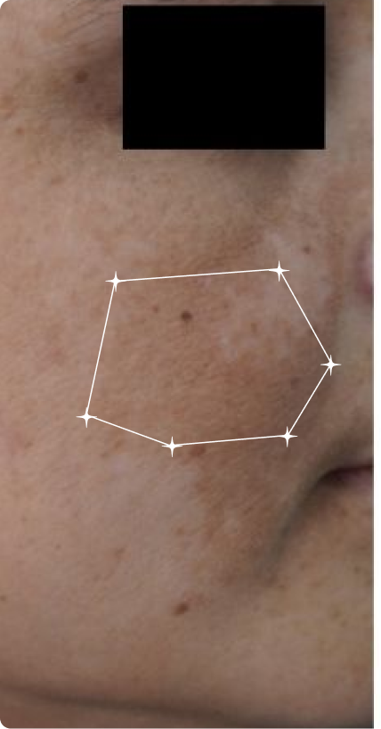 Before — Melasma
