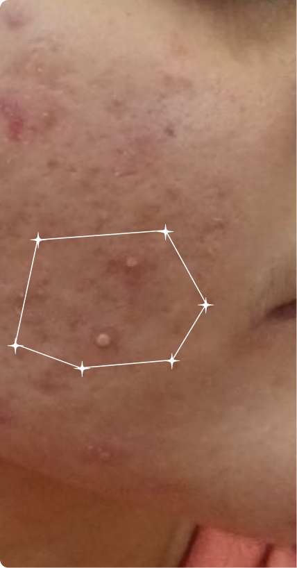 Before — Acne