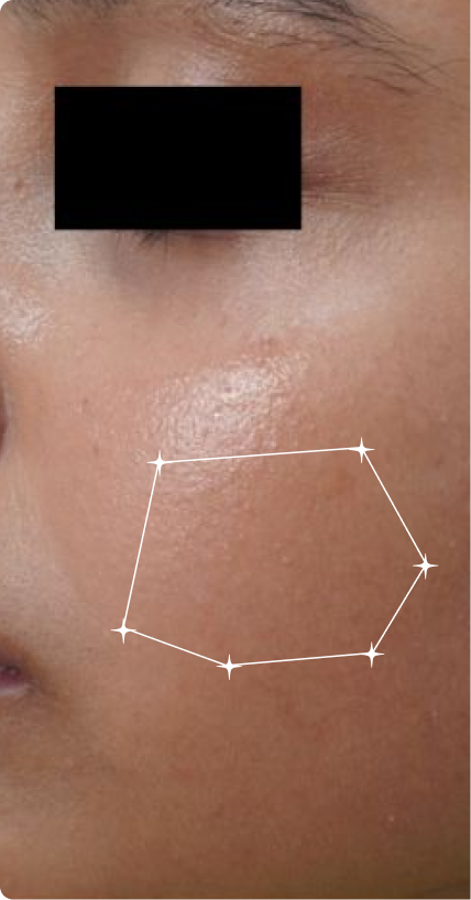 Before — Oily Skin
