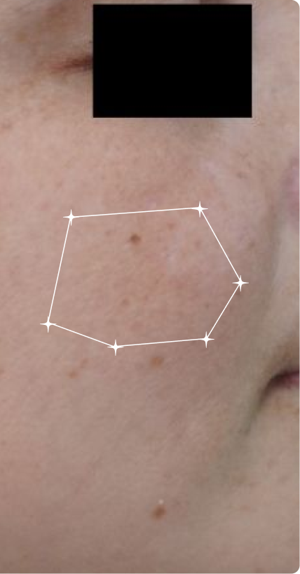 After — Melasma