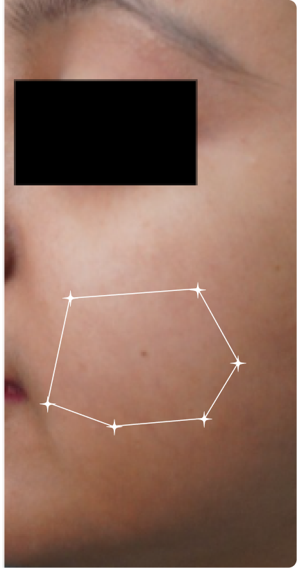 After — Open pores
