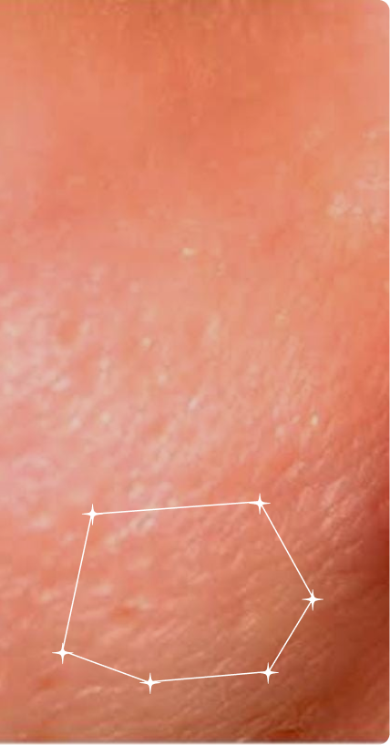 After — Pore congestion
