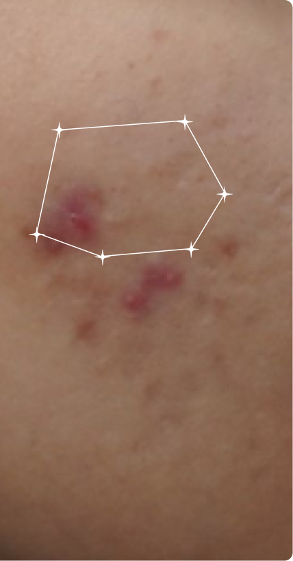 After — Active Acne