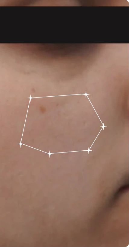 After — Occasional Acne