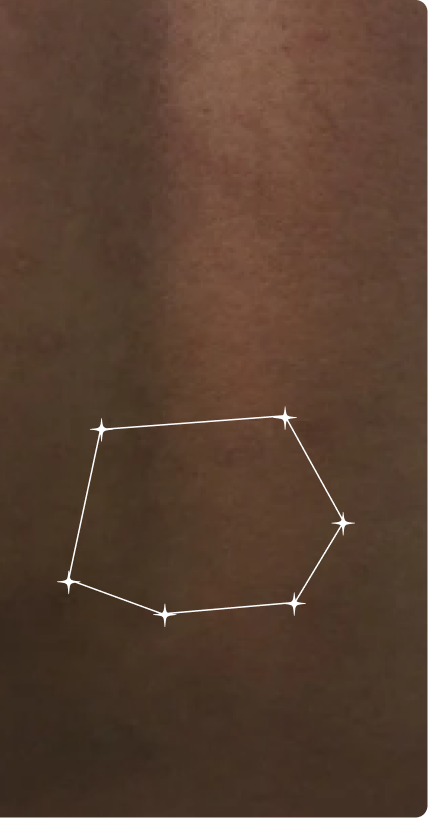 Before — Body Acne