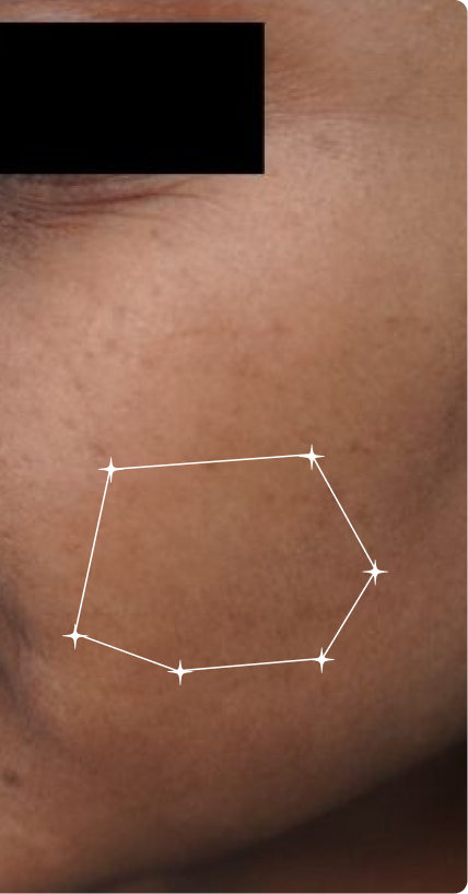 After — Pigmentation