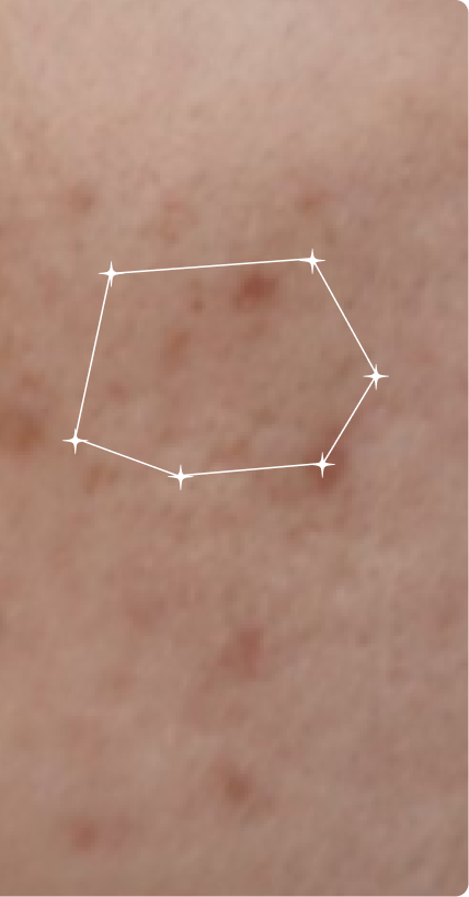 After — Acne