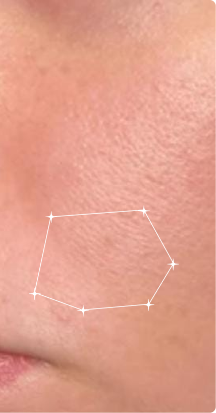 After — Oily Skin