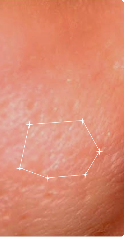 After — Pore Congestion