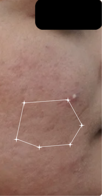 After — Sensitive-Oily