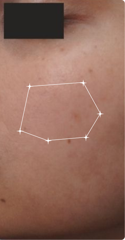 After — Post Acne marks
